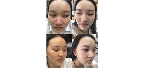 痣福缘：马上要过年了，大小聚会、走亲访友，你的脸准备好了吗？