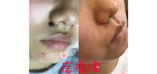 痣福缘：面无善痣言千年，人无障痣事平安！