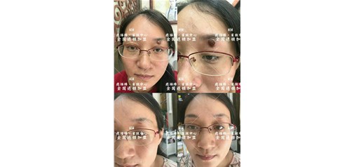 痣福缘：不动刀，不吃药，轻松去除您的脸部烦恼！