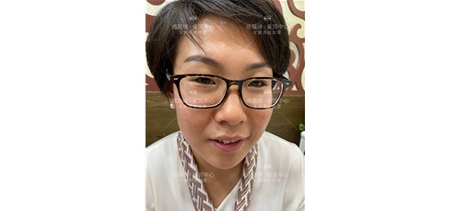 痣福缘：痣福缘雀斑效果反馈图