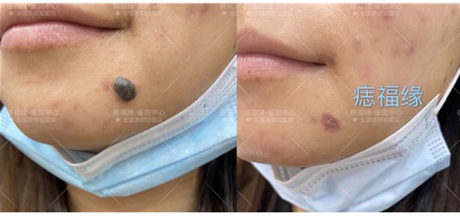 痣福缘：特殊部位血管痣刚掉痂效果！