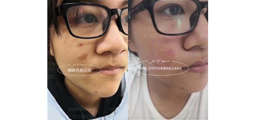 痣福缘：胎记痣前后效果对比！