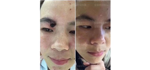 痣福缘：眉毛痣能不能取呢？