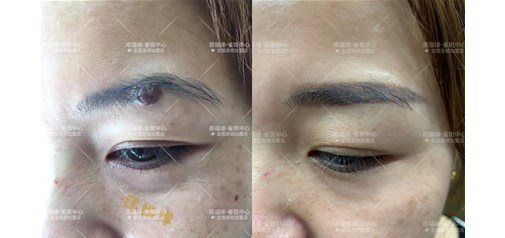 痣福缘：眉毛大痣能不能取？