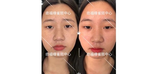 痣福缘：做斑不要走弯路、速成的方法效果一定会反噬！