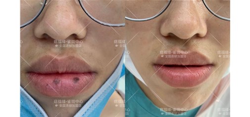 痣福缘：嘴唇特殊部位痣效果展示！